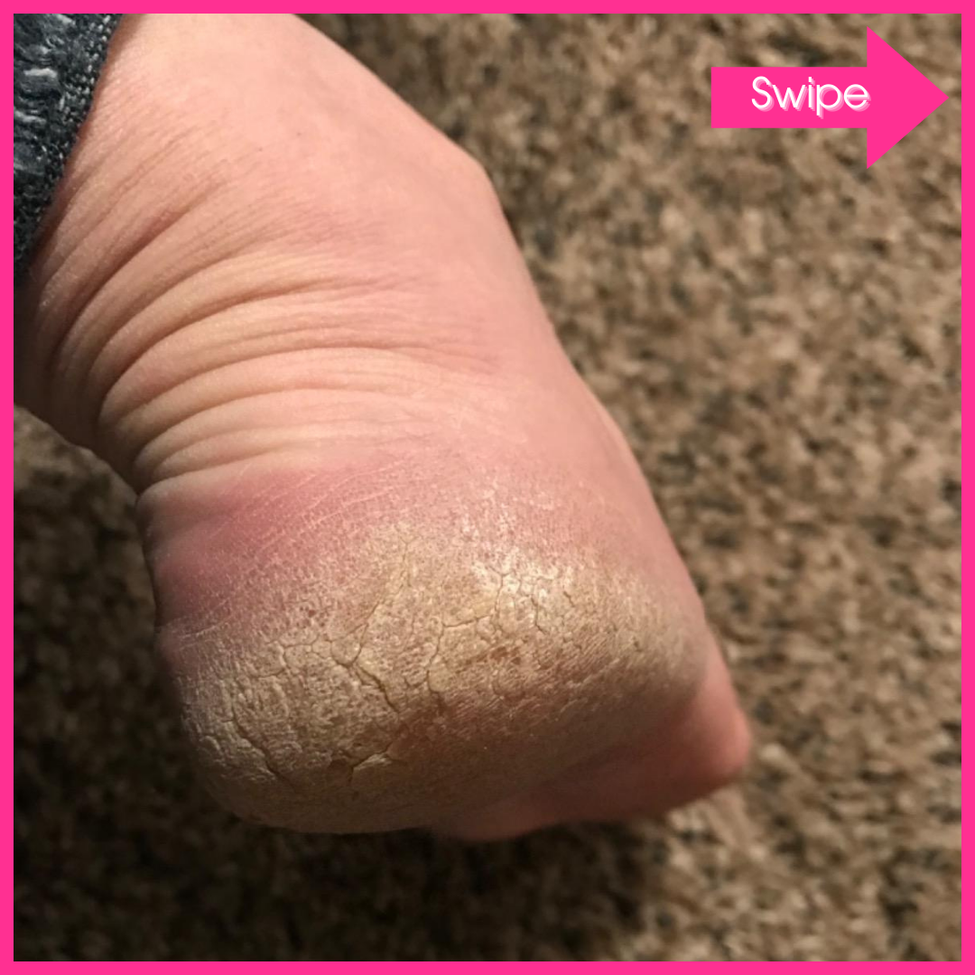 Adora Aura Electric Callus Remover