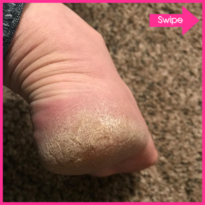 Adora Aura Electric Callus Remover