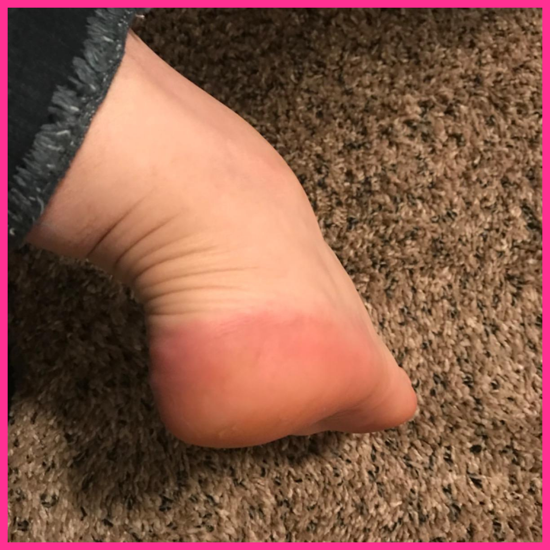 Adora Aura Electric Callus Remover