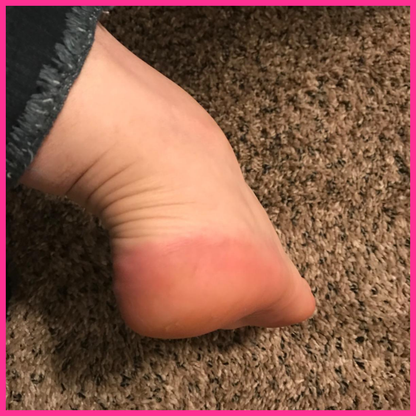 Adora Aura Electric Callus Remover