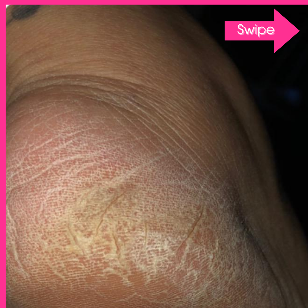 Adora Aura Electric Callus Remover