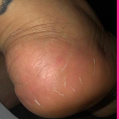 Adora Aura Electric Callus Remover
