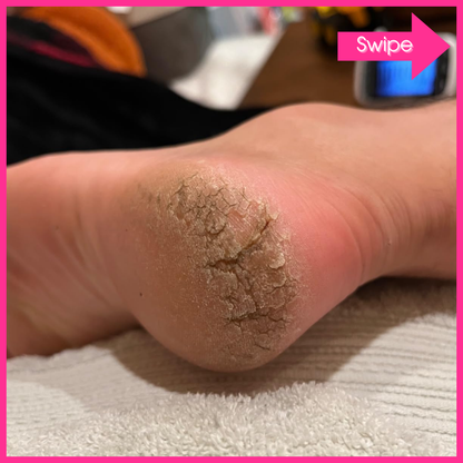 Adora Aura Electric Callus Remover