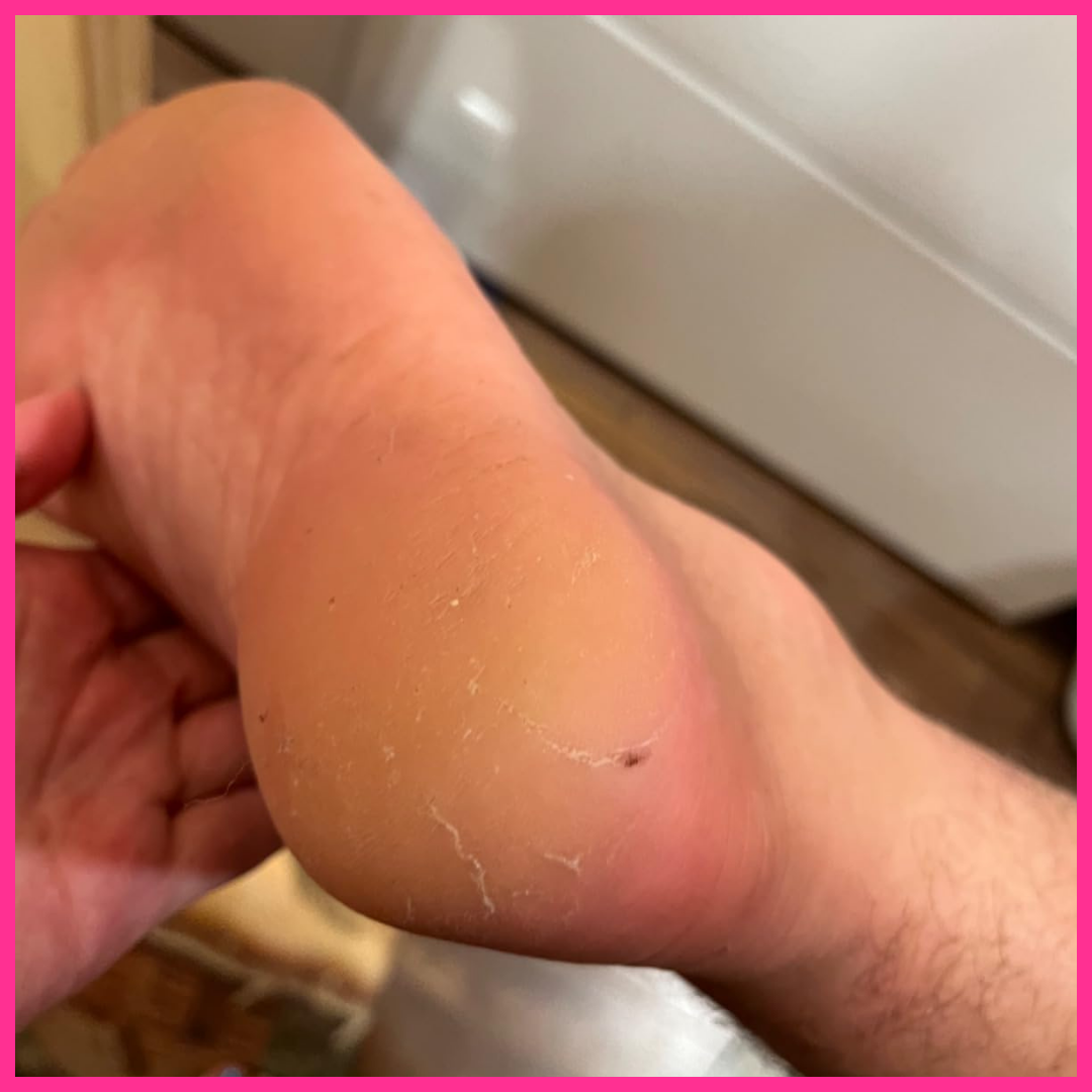 Adora Aura Electric Callus Remover